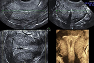 3D/4D Ultrasound - Gynecology Oncology